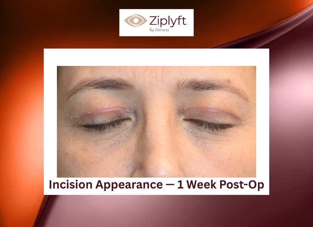 Seven days post-op incision after ZipLyft