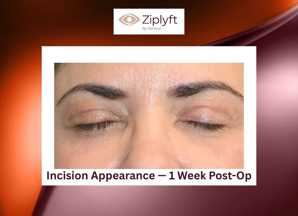 Seven days post-op incision close-up after ZipLyft