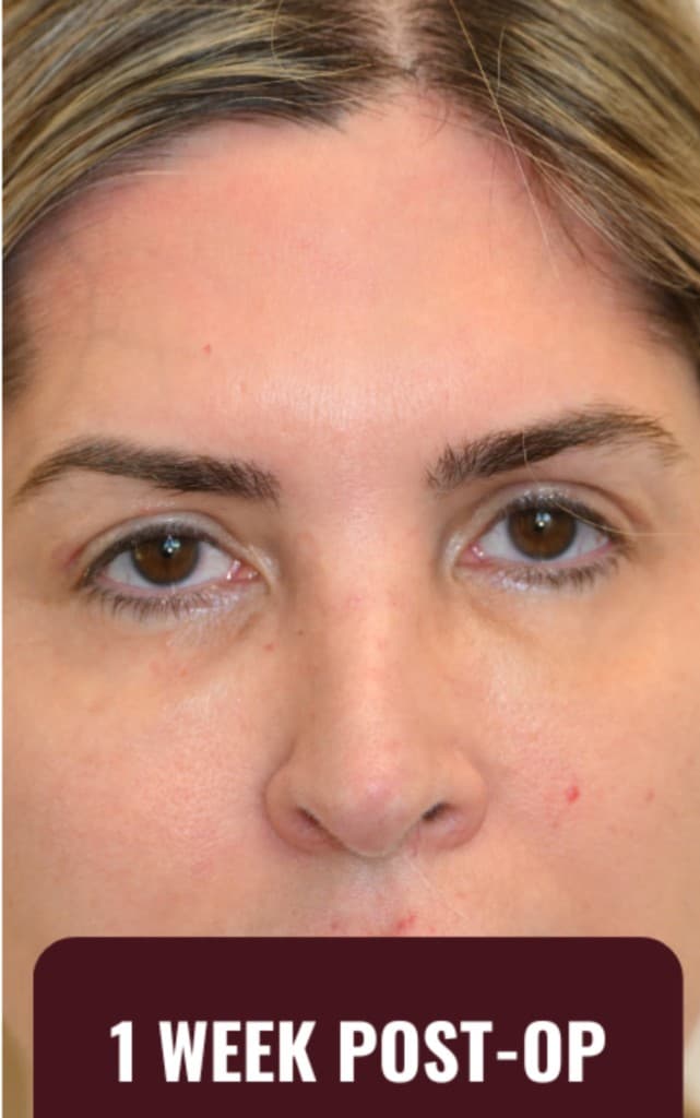 One week post-op after ZipLyft