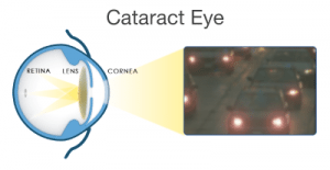 cataracts_cataract