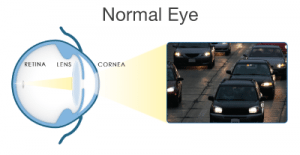cataracts_norm