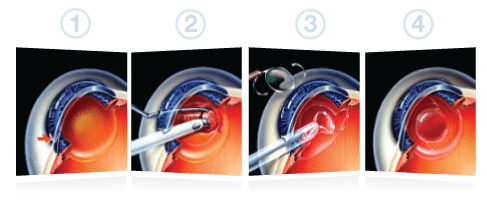cataracts_surgery_-procedure