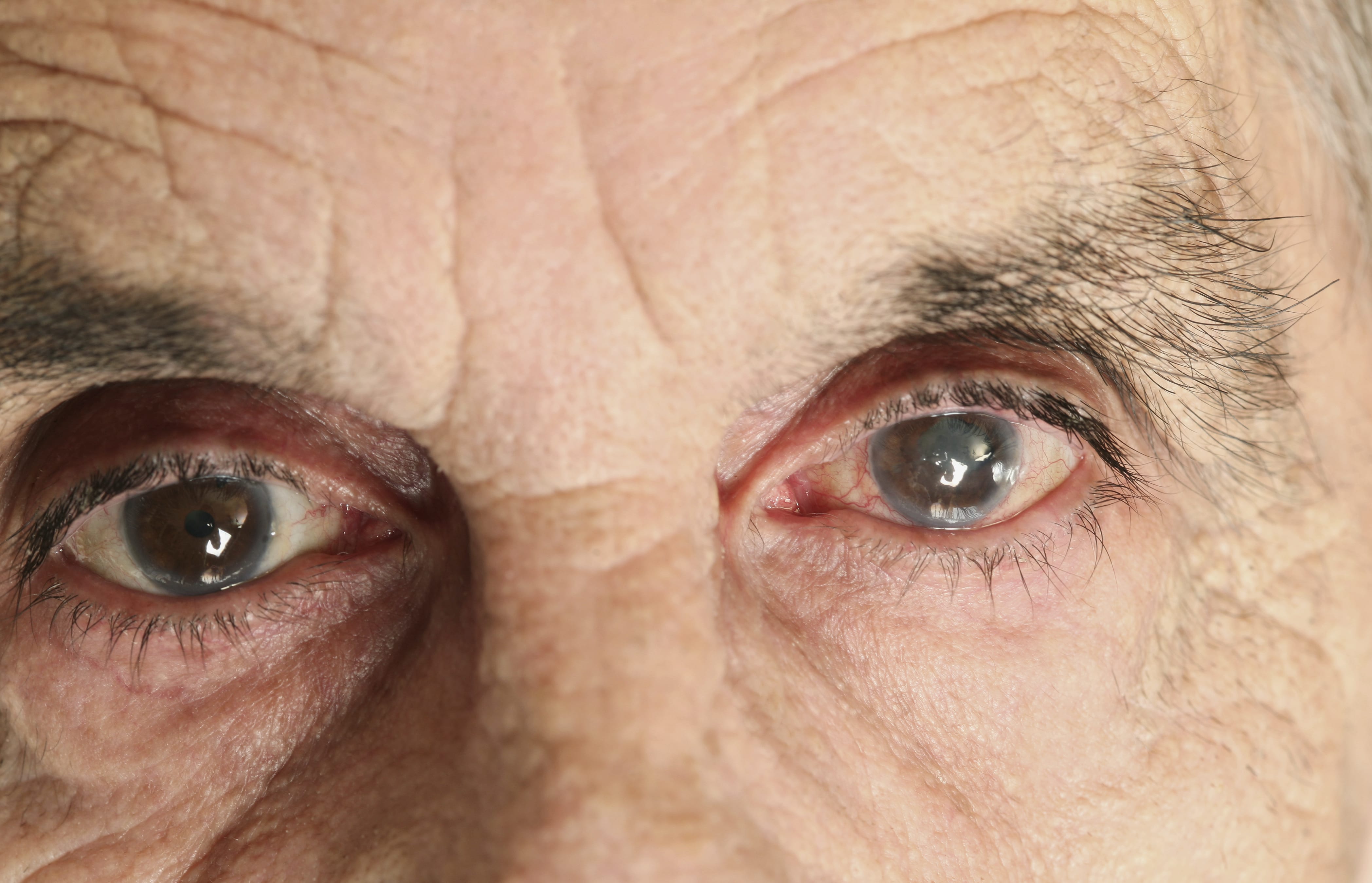 Senior's eyes with cataract and glaucoma.