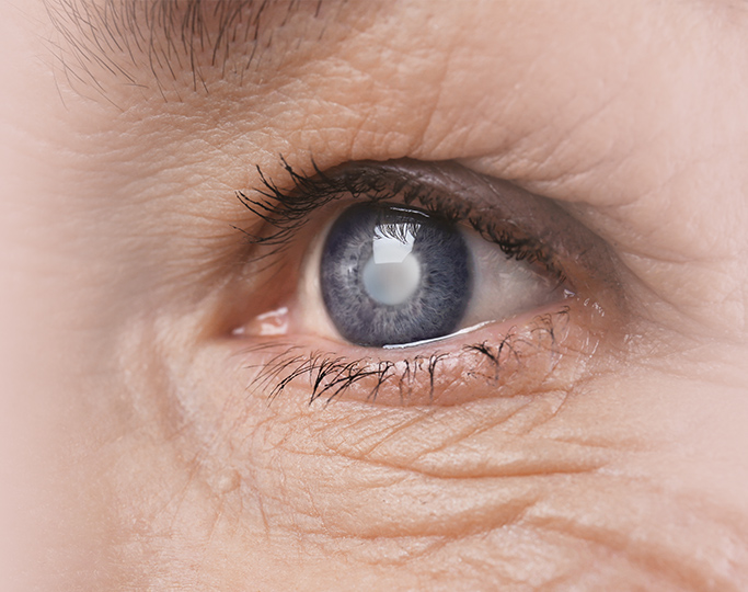 Cataract Image